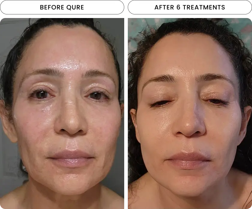 Micro-Infusion 6 Month (For Wrinkles + Dark Spots) - Image 4