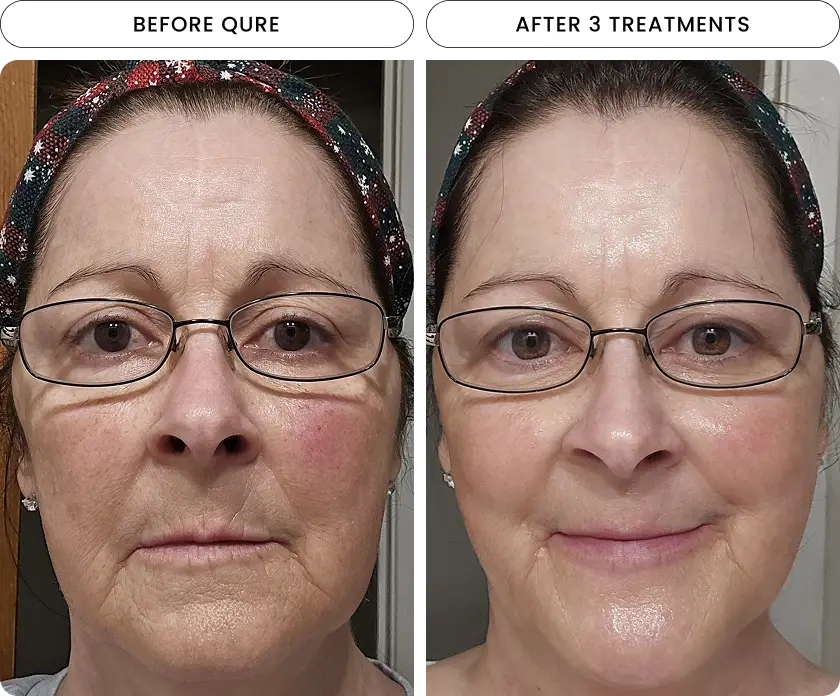 Micro-Infusion 6 Month Bundle (For Dark Spots) - Image 2